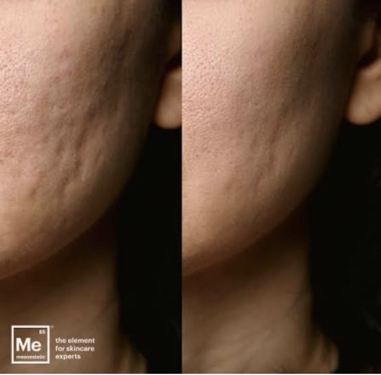 Skinmark by mesoestetic (marcas de acné)